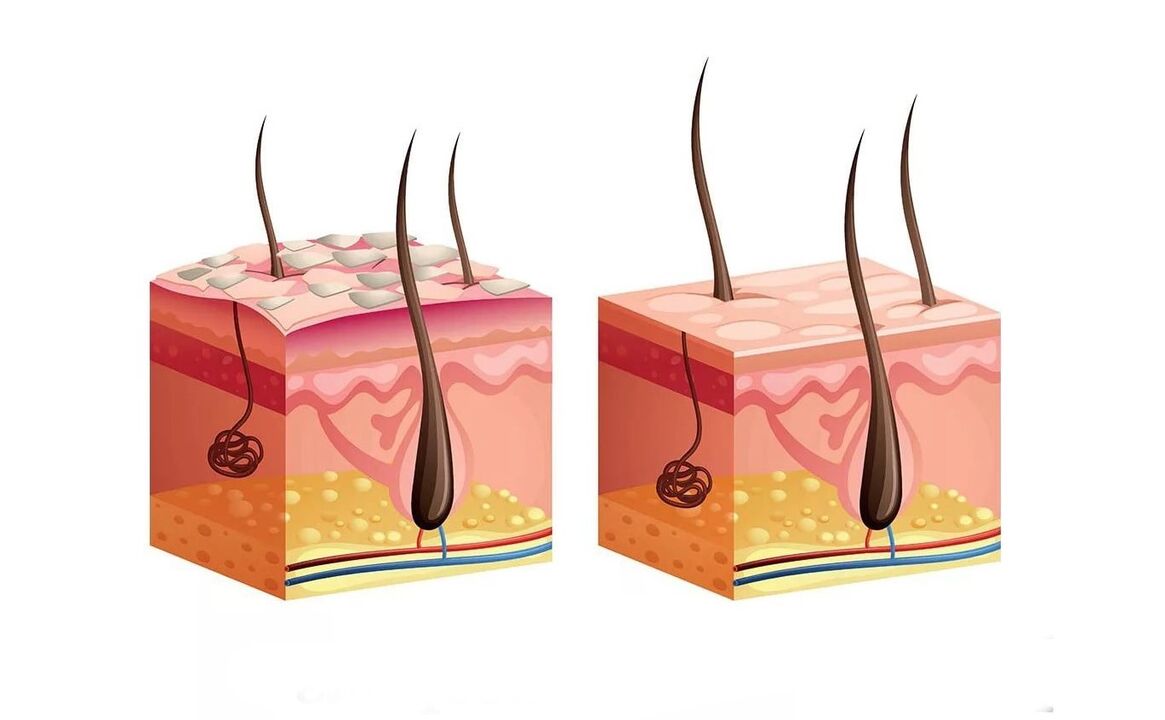 Psoriasis skin before and after applying the cream