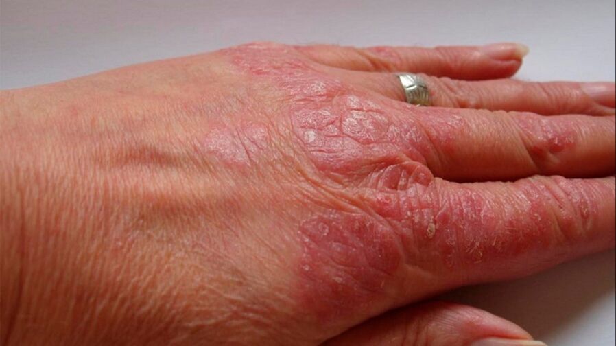 symptoms of psoriasis on hands