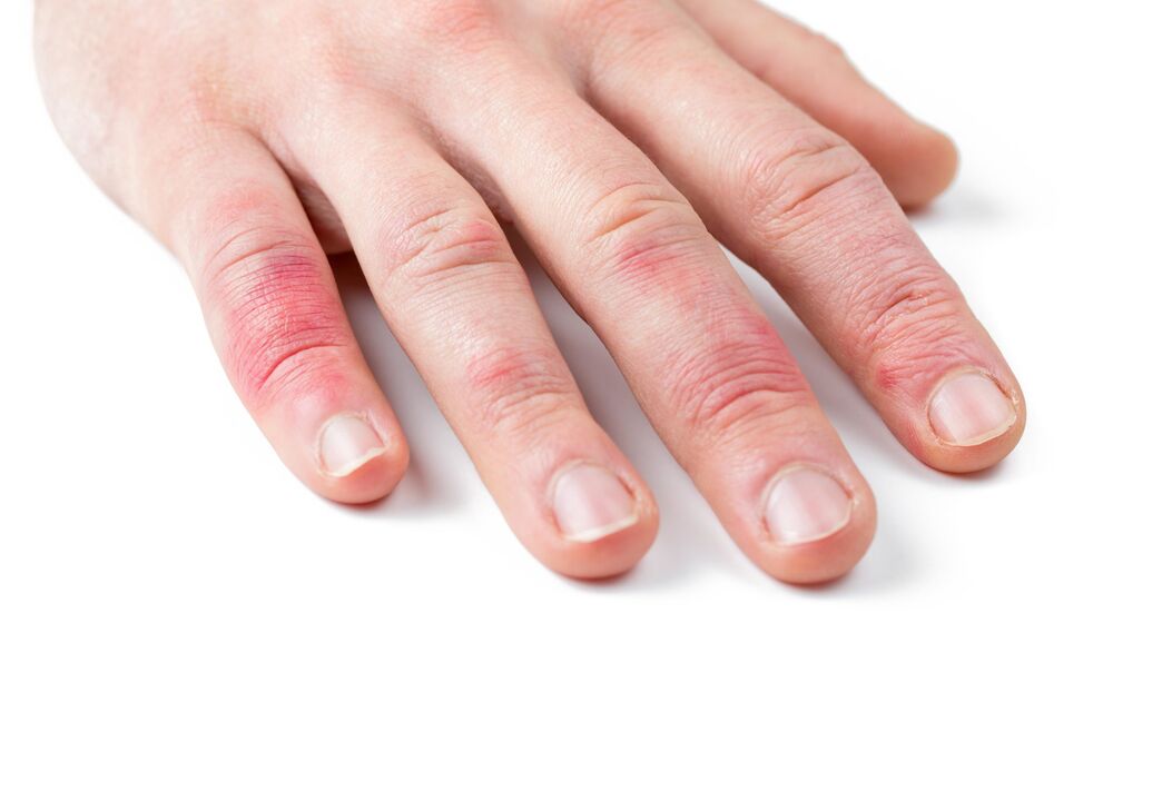 psoriasis on children's hands