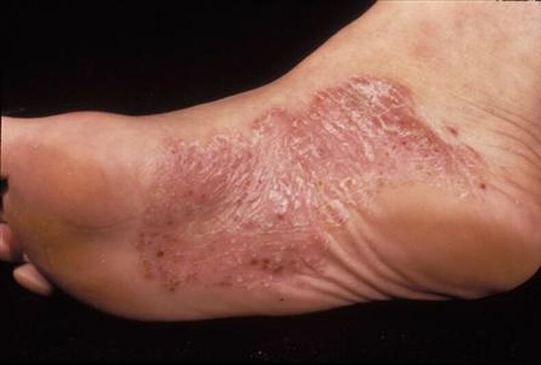 Symptoms of Psoriasis on the Feet