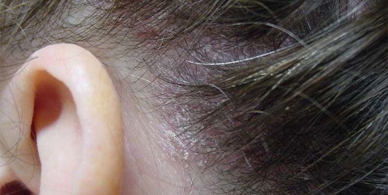 advanced stage of psoriasis on the head