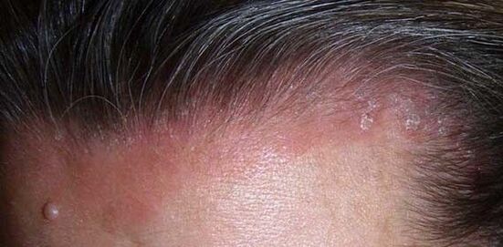 manifestations of psoriasis on the head