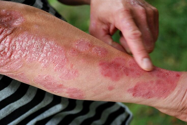 Psoriasis patches on arms
