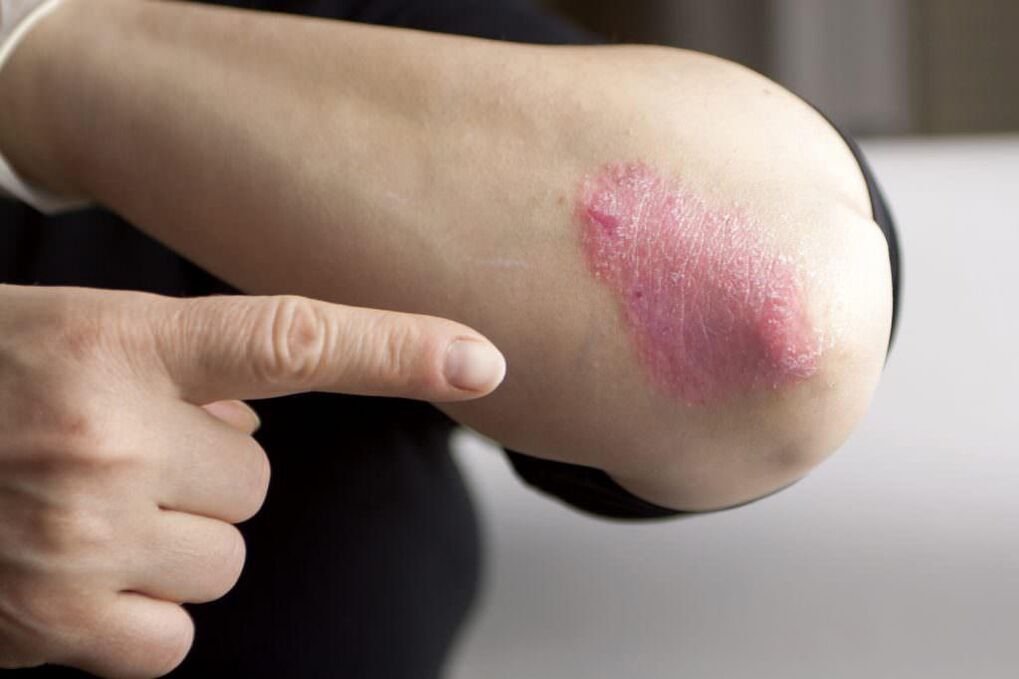 Symptoms of the early stages of elbow psoriasis
