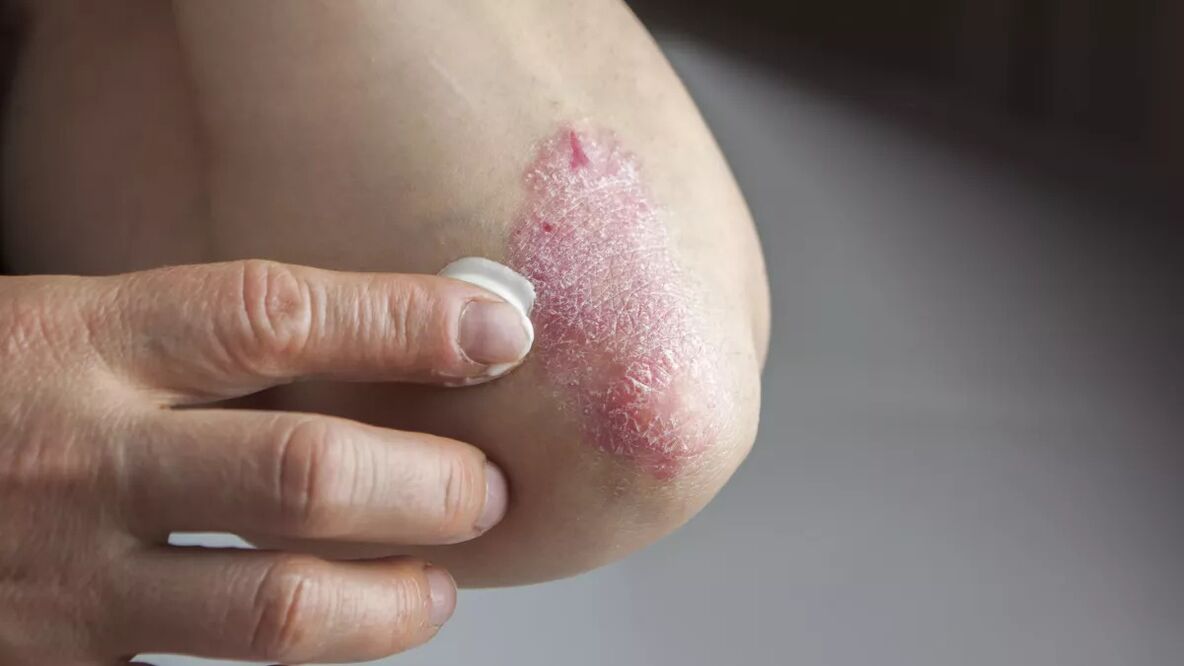 Treat psoriasis on elbows with topical cream