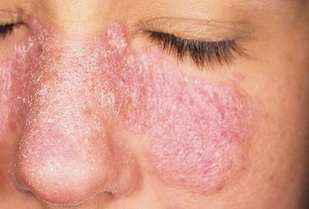 Advanced stages of psoriasis on the face