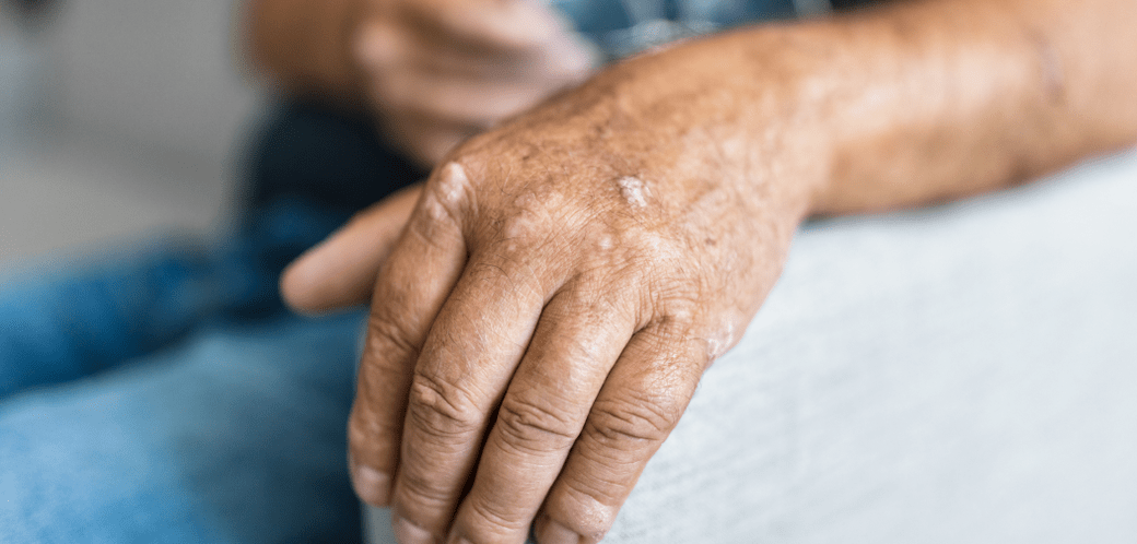 Psoriasis on hand skin