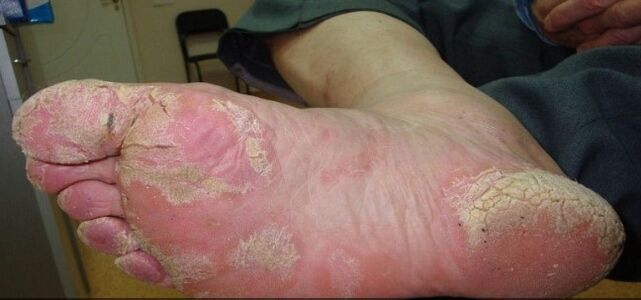 Psoriasis on legs