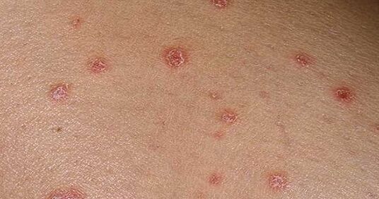 Psoriasis