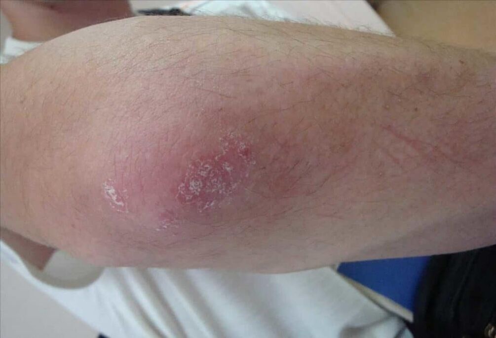 Psoriasis looks like