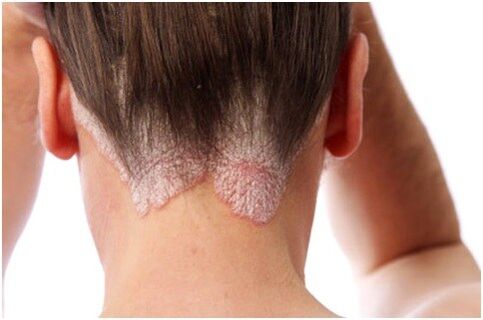 Psoriasis on hair
