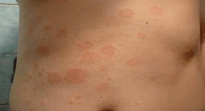 Lucky psoriasis