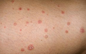 Psoriasis