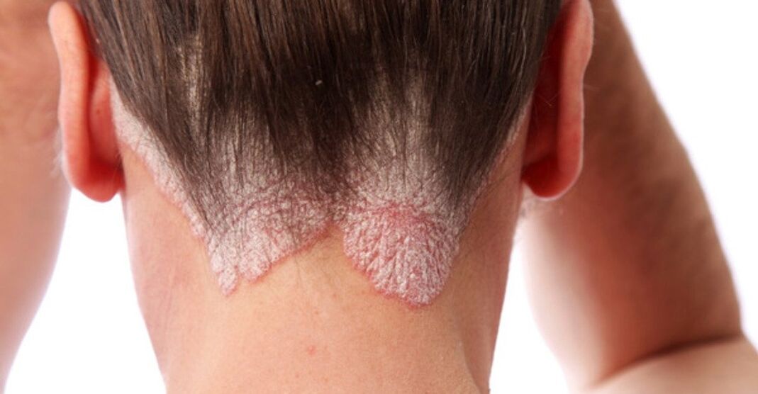 Psoriasis on the heads of girls