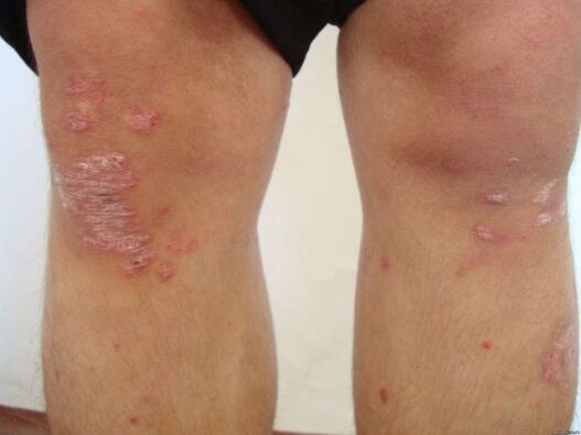 Causes of psoriasis