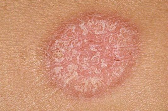 Psoriasis