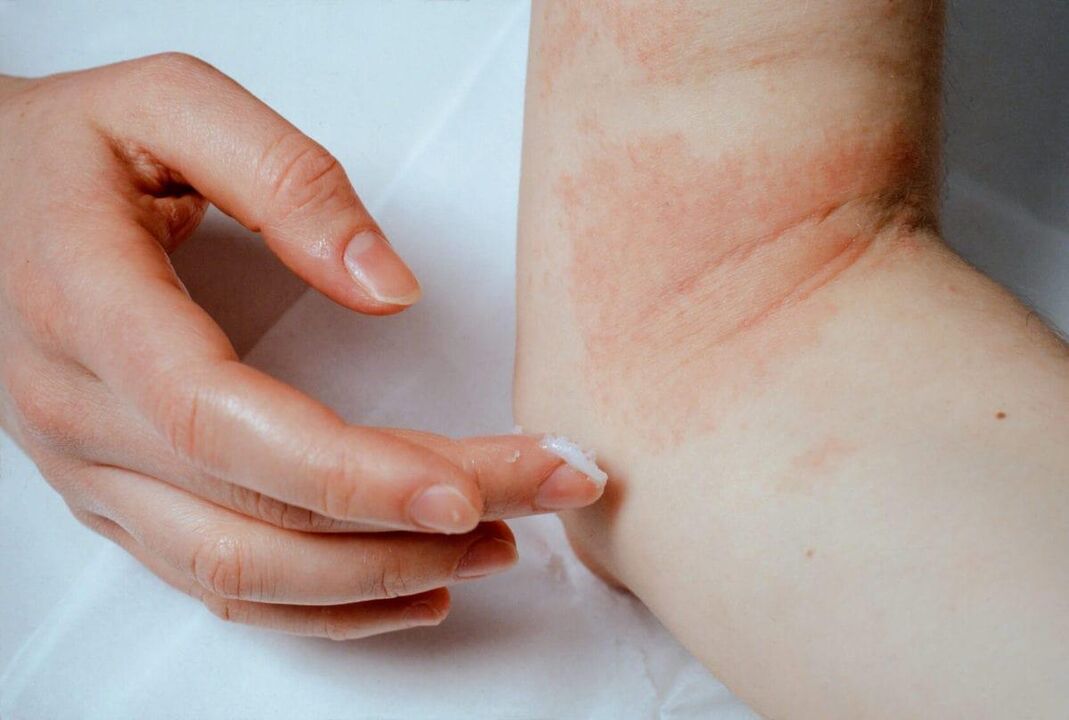 Treatment of psoriasis