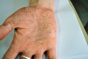 Psoriasis in your palm
