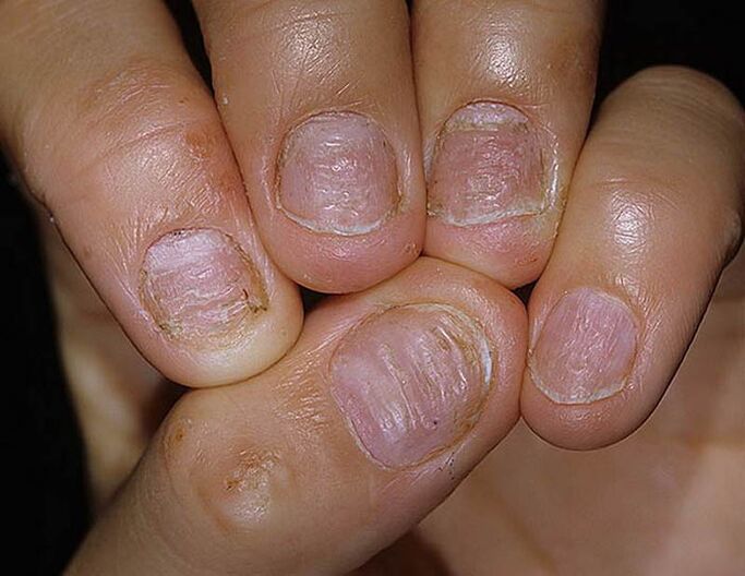 Psoriasis of nails