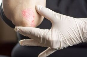 Psoriasis on the elbows