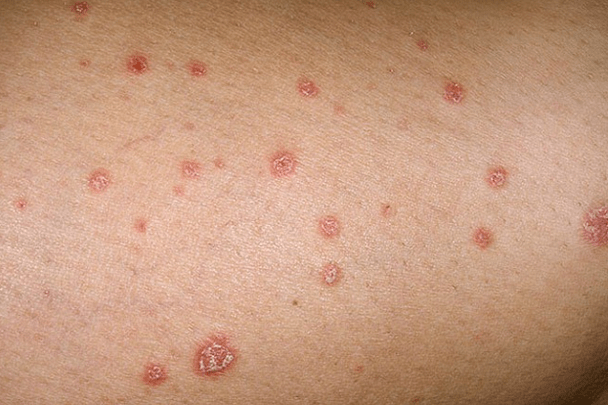 psoriasis plaques