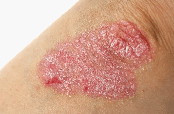 Advanced stages of psoriasis