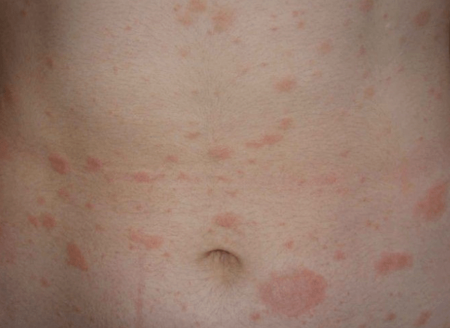 Regression phase of psoriasis