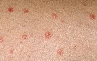 Psoriasis in the early stages