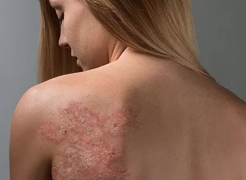 Psoriasis on the girl's back