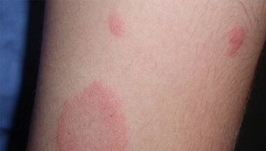 How does the early stages of psoriasis appear