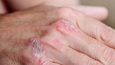 Symptoms of the early stages of psoriasis