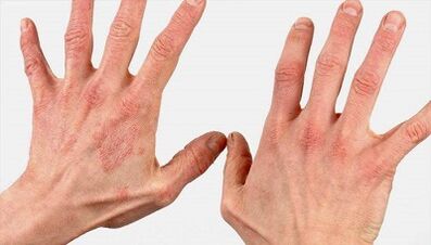 What the early stages of psoriasis look like
