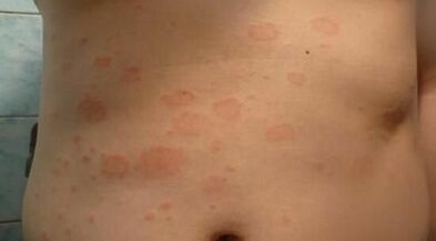 How to recognize the early stages of psoriasis