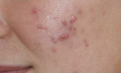 Symptoms of the early stages of psoriasis