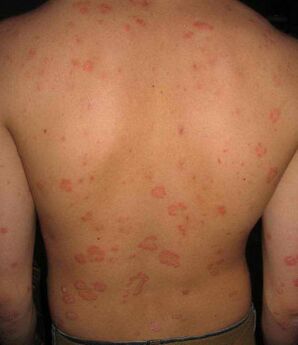 Psoriasis on the back