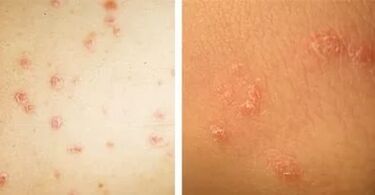 main manifestation of psoriasis