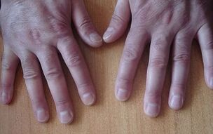 symptoms of psoriasis in the early stages