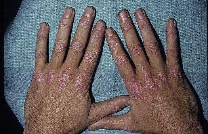 Causes of psoriasis development on hands