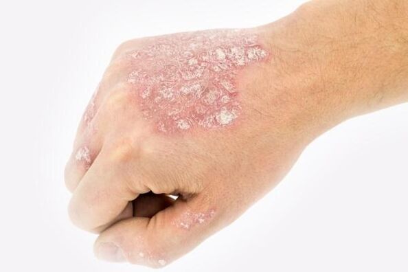 Mechanism of development of psoriasis on hands