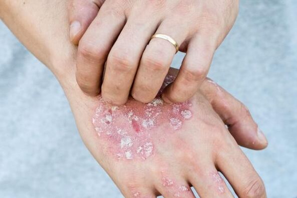 Typical symptoms of psoriasis on hands