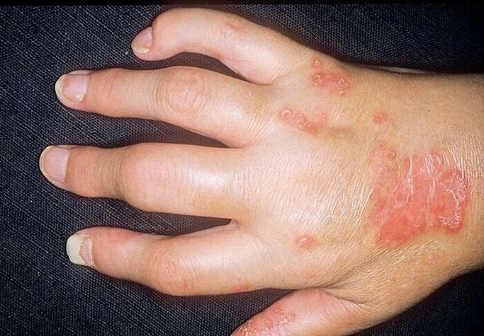 Psoriatic arthritis on the hands