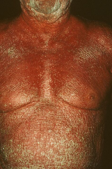 Psoriatic erythema