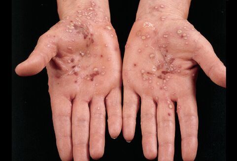 What is psoriasis in the palm of the hand looks like