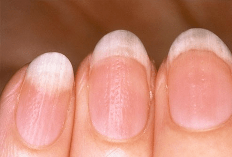 nail psoriasis