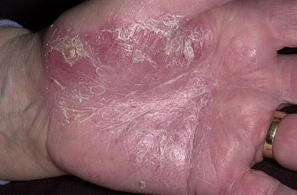 psoriasis on the palm of the hand
