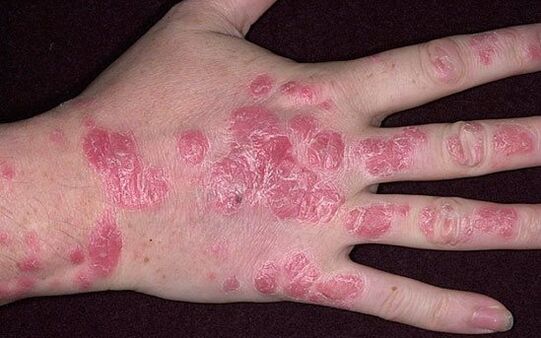 psoriasis plaque on hands