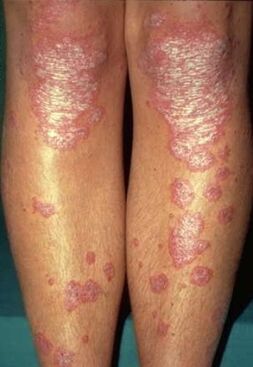 Manifestations of psoriasis in the legs