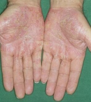 Psoriasis in the palm of the hand