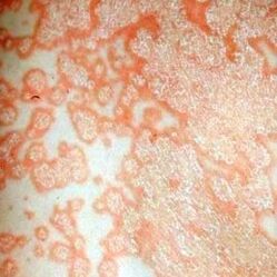 Psoriasis patches on the body