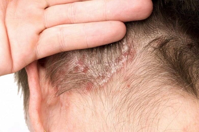 picture of psoriasis on the head